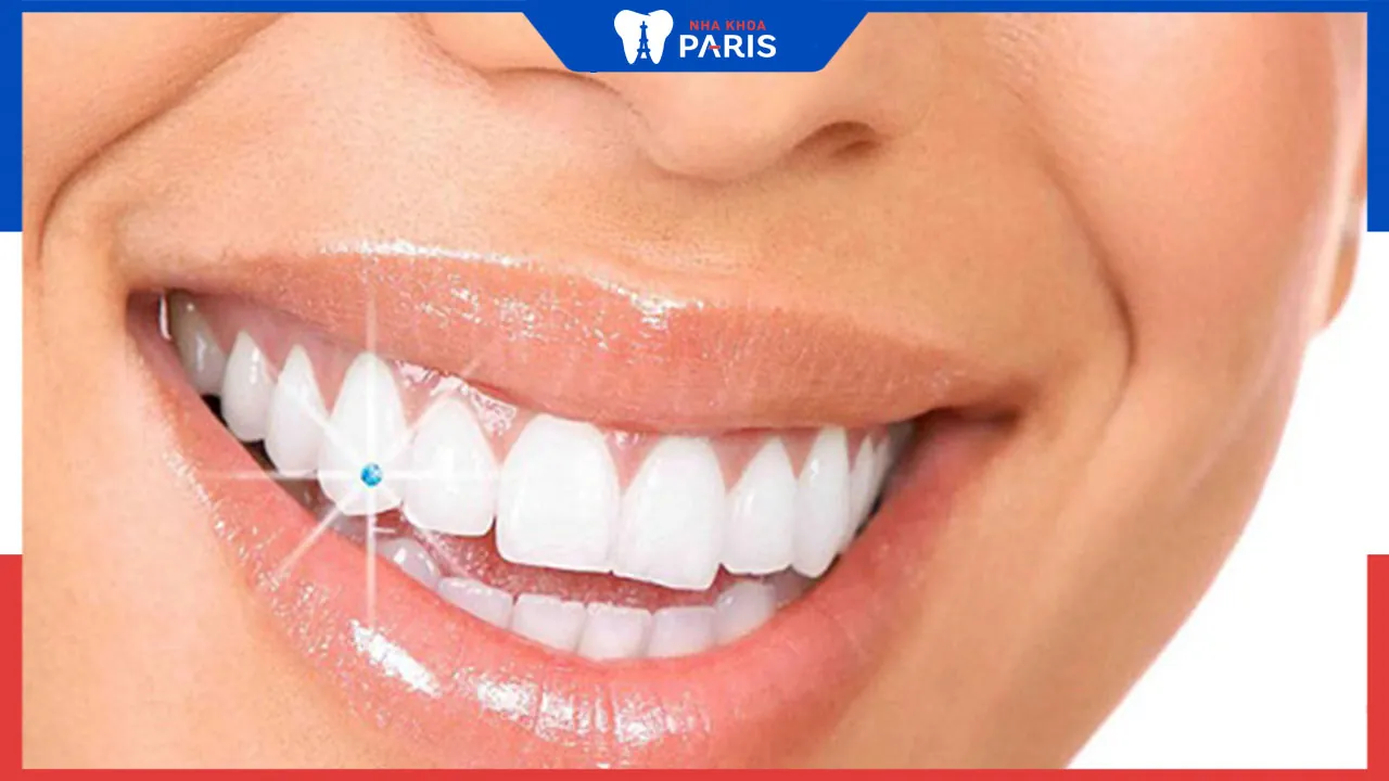 Đính hạt đá vào răng vị trí nào đẹp, nên đính đá vào răng nào?