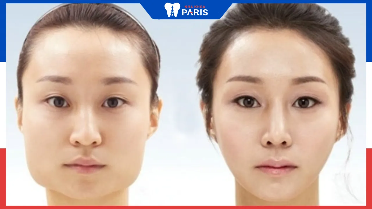 Gọt hàm mặt vuông là gì? 5 điều cần biết về phẫu thuật gọt hàm
