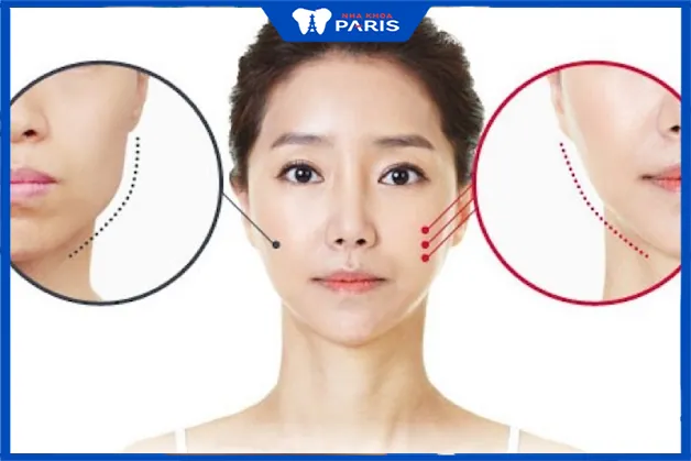 Địa chỉ gọt mặt V-Line ở đâu đẹp và uy tín nhất?