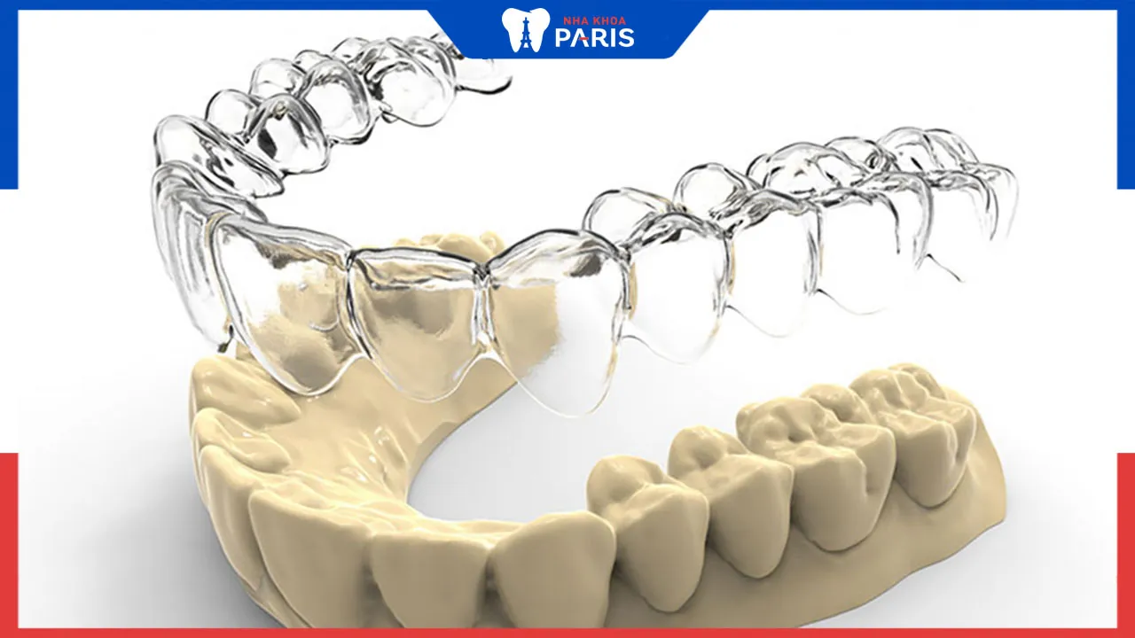 Niềng răng trong suốt 1 hàm được không? Niềng ở đâu có kết quả tốt