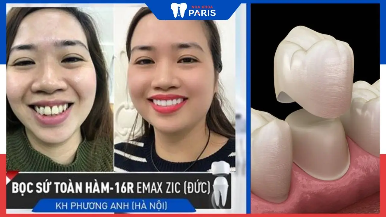 Có nên bọc răng chỉnh hô không, Lưu ý quan trọng