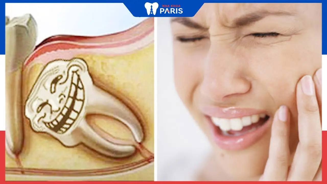 Đau răng khôn không ngủ được? 5 cách giúp giảm nhẹ khi đau