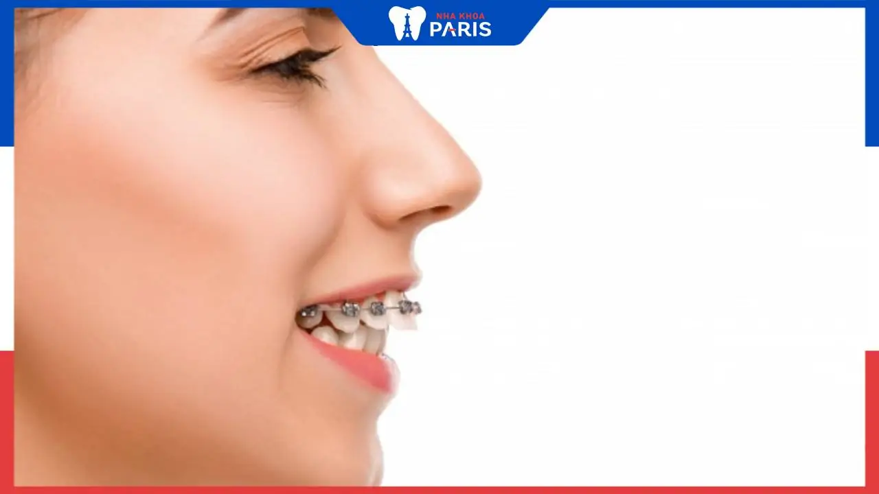 Niềng răng bao lâu thì tháo? các mốc thời gian cần biết