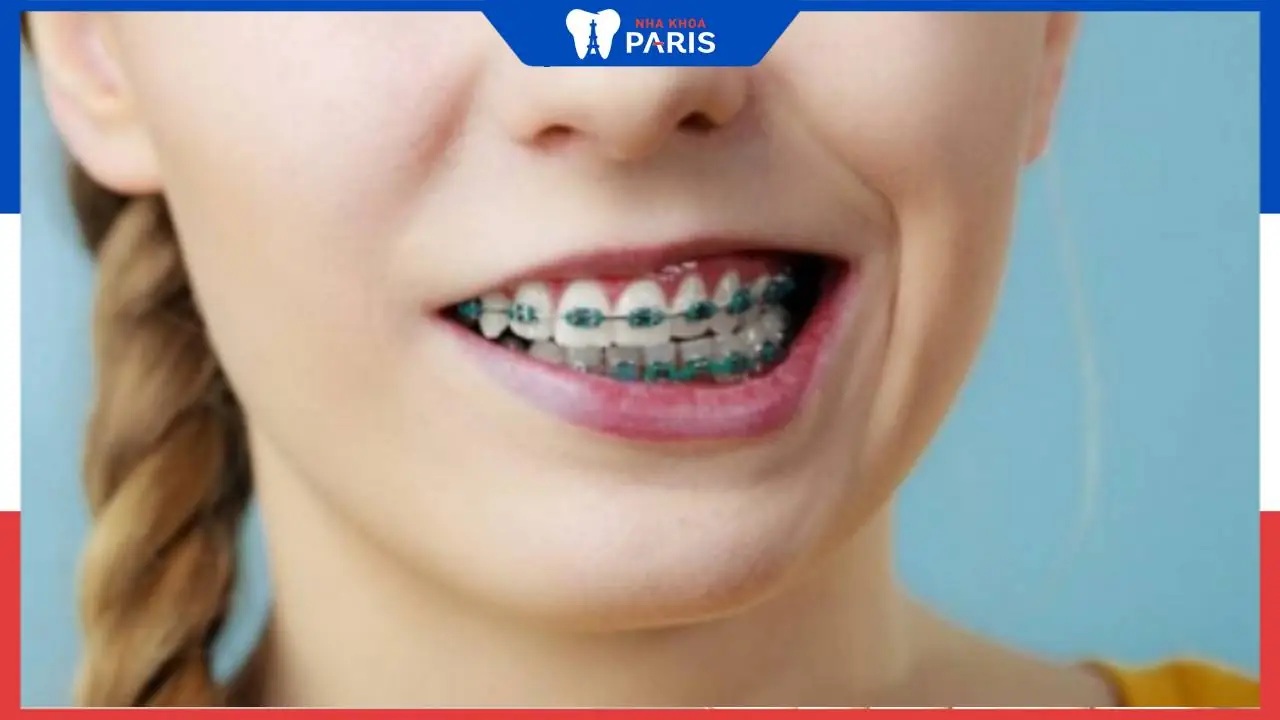 Hỏi đáp: Niềng răng lệch cằm có làm hết cằm lệch không? 