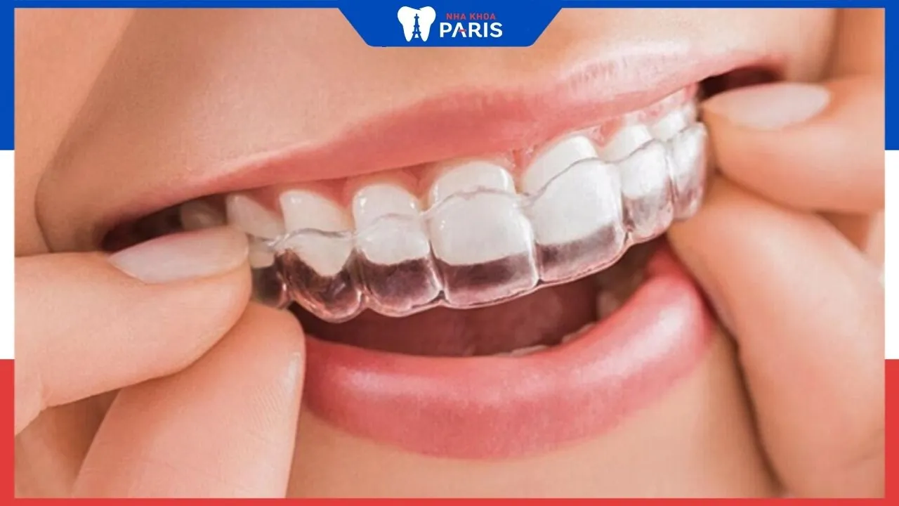 Niềng răng khay trong và tổng hợp thông tin cần biết