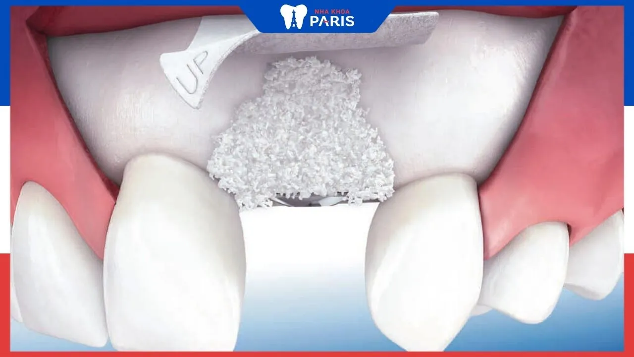 Phẫu thuật ghép xương mặt trong cấy ghép Implant