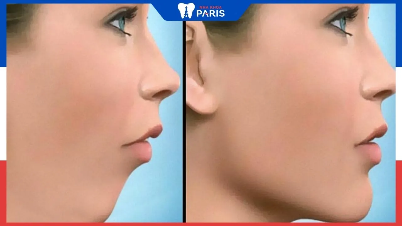 Phẫu thuật hàm hô 2 hàm được không? Có nguy hiểm không