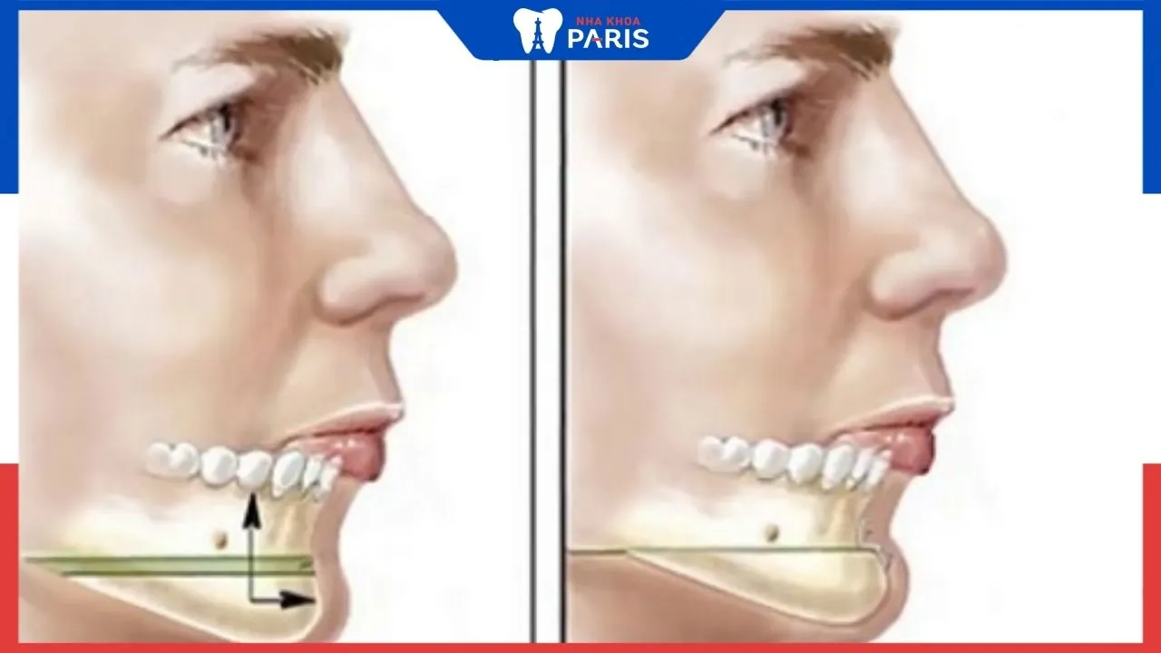 Phẫu thuật tạo cằm Vline bằng trượt hàm có nguy hiểm không
