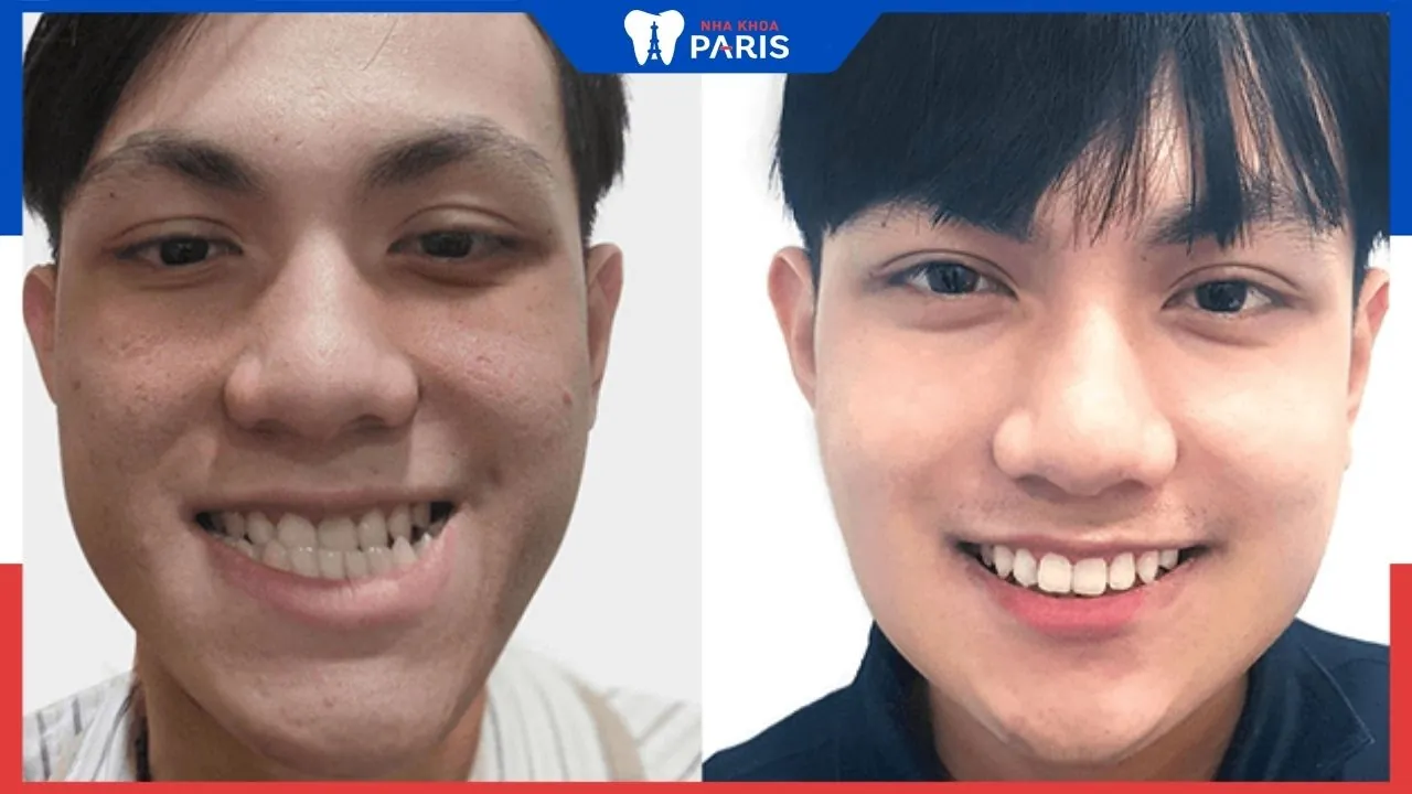Phẫu thuật vẩu hàm dưới khắc phục 100% mặt lưỡi cày