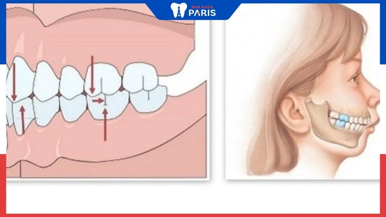 Phẫu thuật xương hàm trên và những điều nhất định phải biết