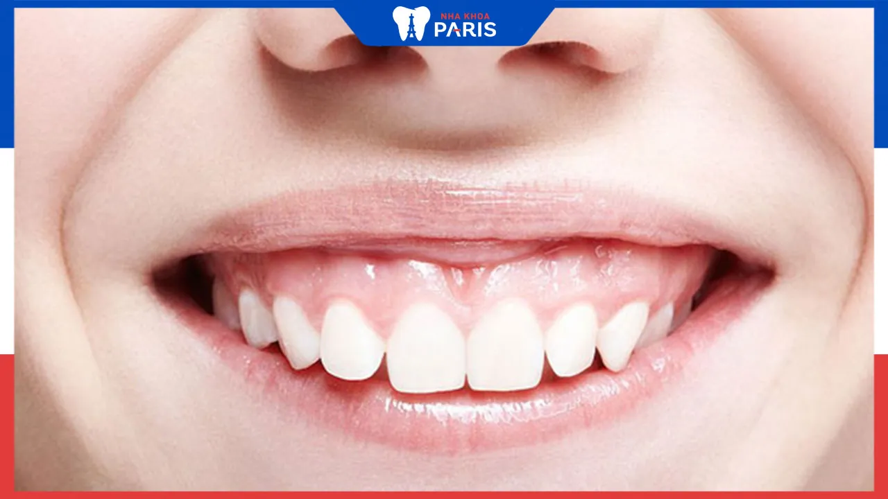 Răng ngắn cười hở lợi là gì? Cách chữa trị dứt điểm