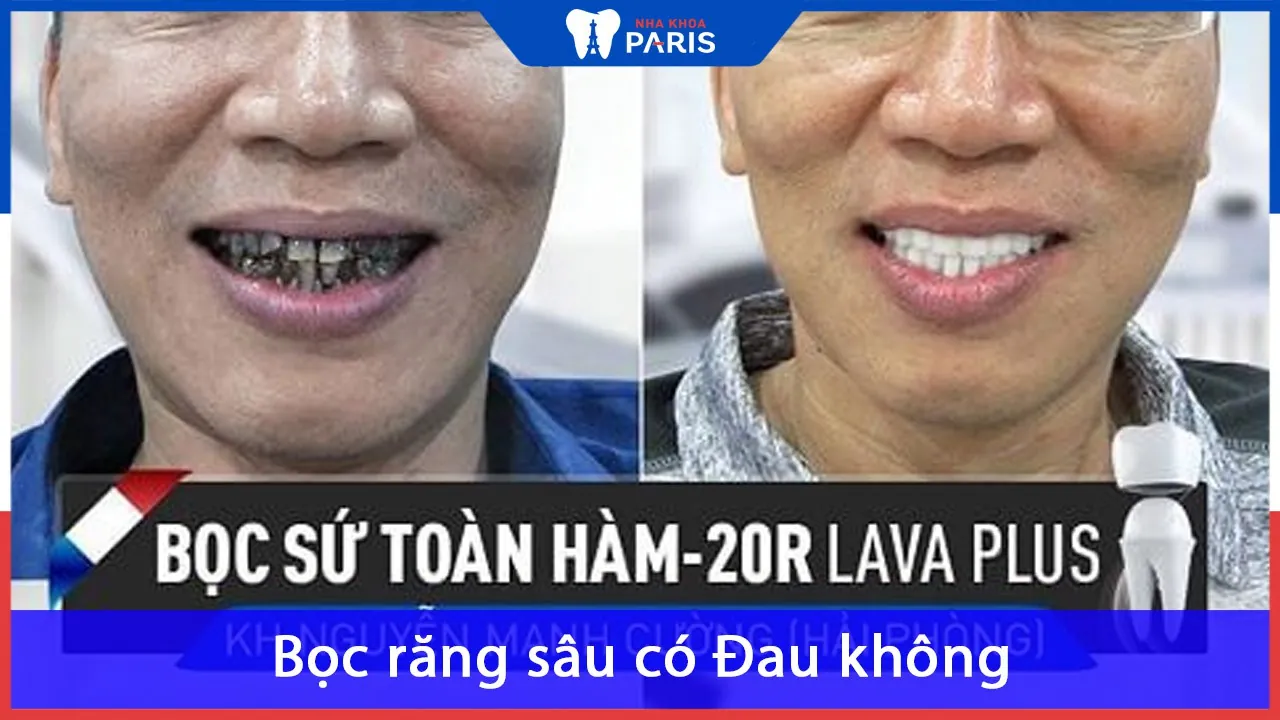 Răng bị sâu có bọc sứ được không? Giá bao nhiêu tiền?