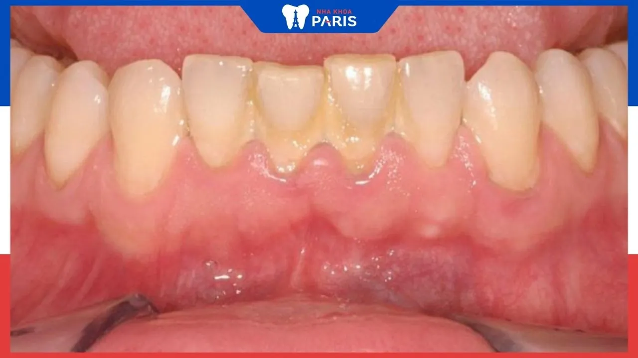 10+ Cách cạo vôi răng tại gia nhanh chóng, hiệu quả