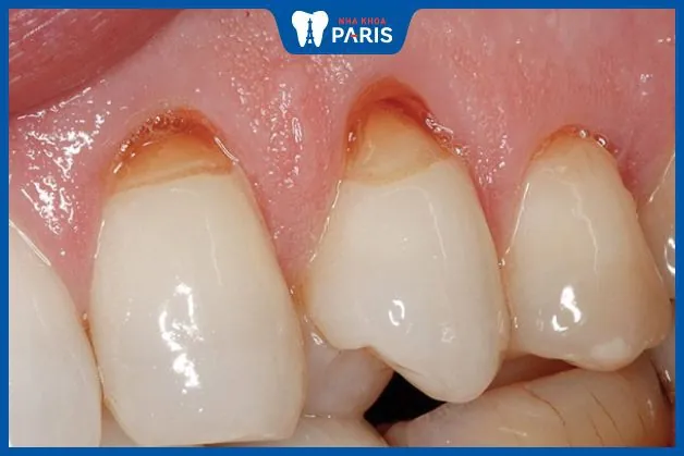 Tại sao chân răng bị mục, hư, yếu dần đi? Cách điều trị hiệu quả