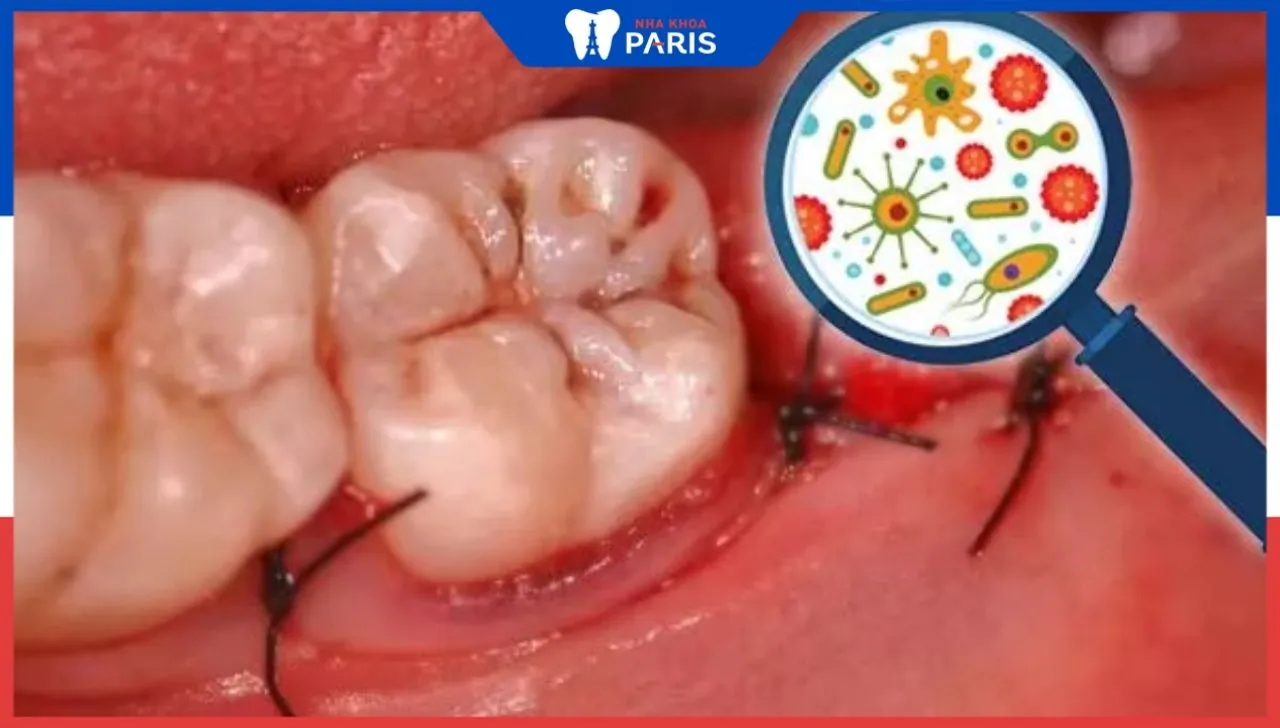 Nhổ răng sâu có hết hôi miệng không? Nha khoa Paris giải đáp