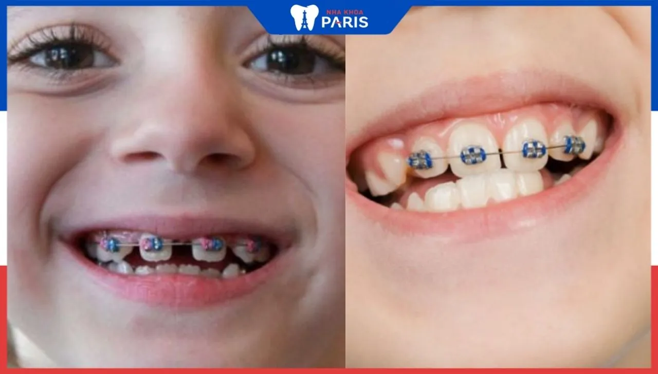 Niềng răng thưa cho trẻ em: ưu/nhược điểm và giá bao nhiêu?