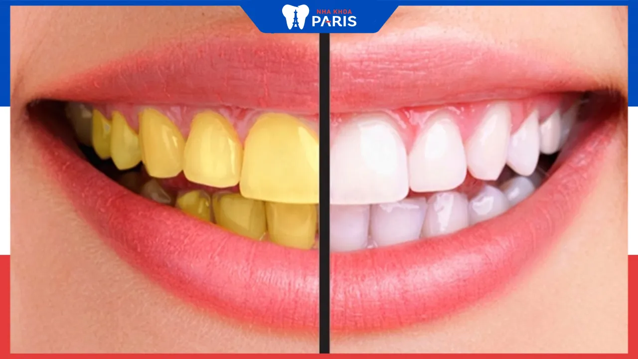 Răng ố vàng sau khi sinh? Nguyên nhân và cách điều trị