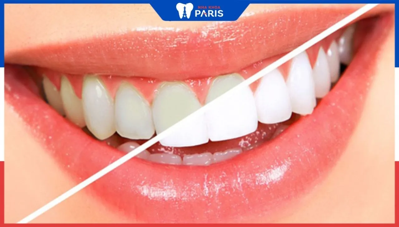 Máy tẩy trắng răng White Light có tốt không?