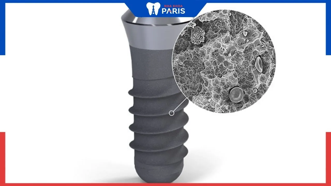 Trụ Implant Straumann SLA và 3 lợi thế đột phá