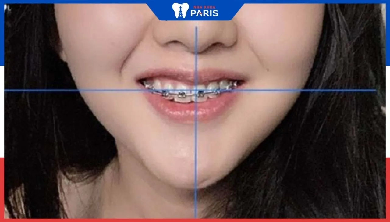 Niềng răng có hết lệch mặt không | Lưu ý quan trọng