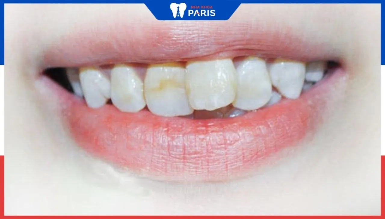 Niềng răng cửa lệch như thế nào? Giải đáp câu hỏi về răng cửa mọc lệch