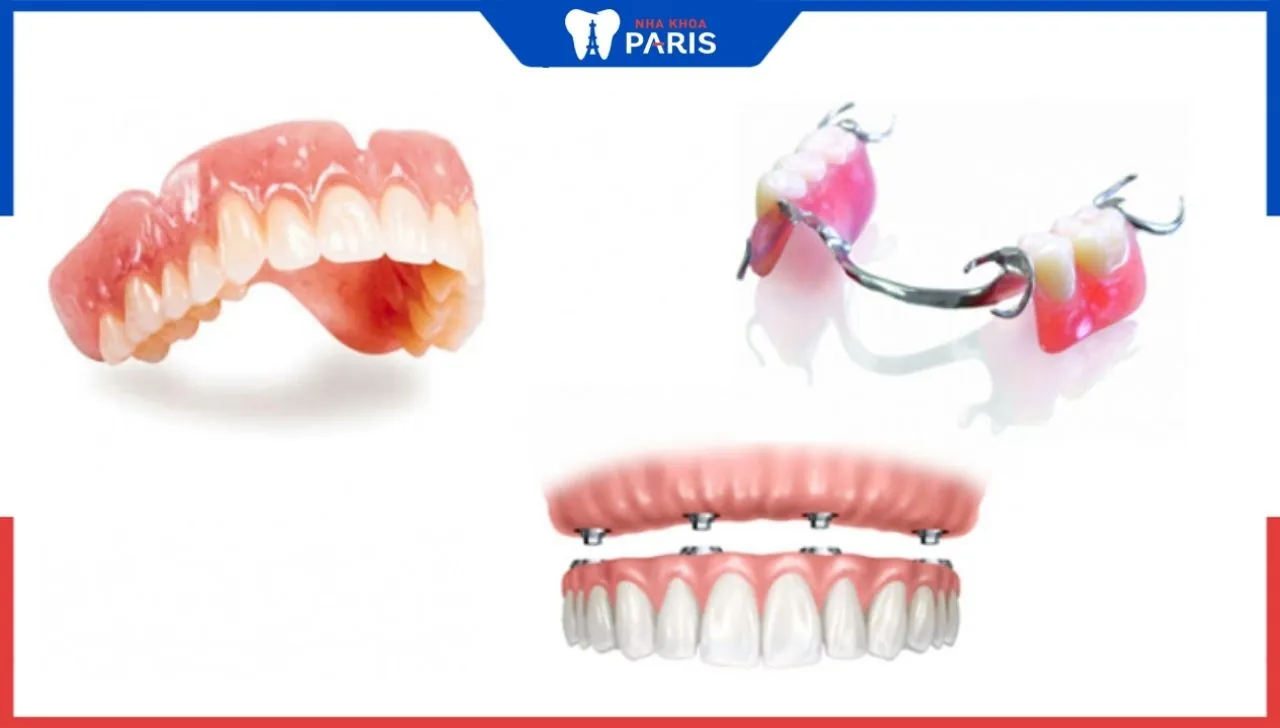 Trồng răng giả tháo lắp: Ưu điểm, giá thành bao nhiêu?