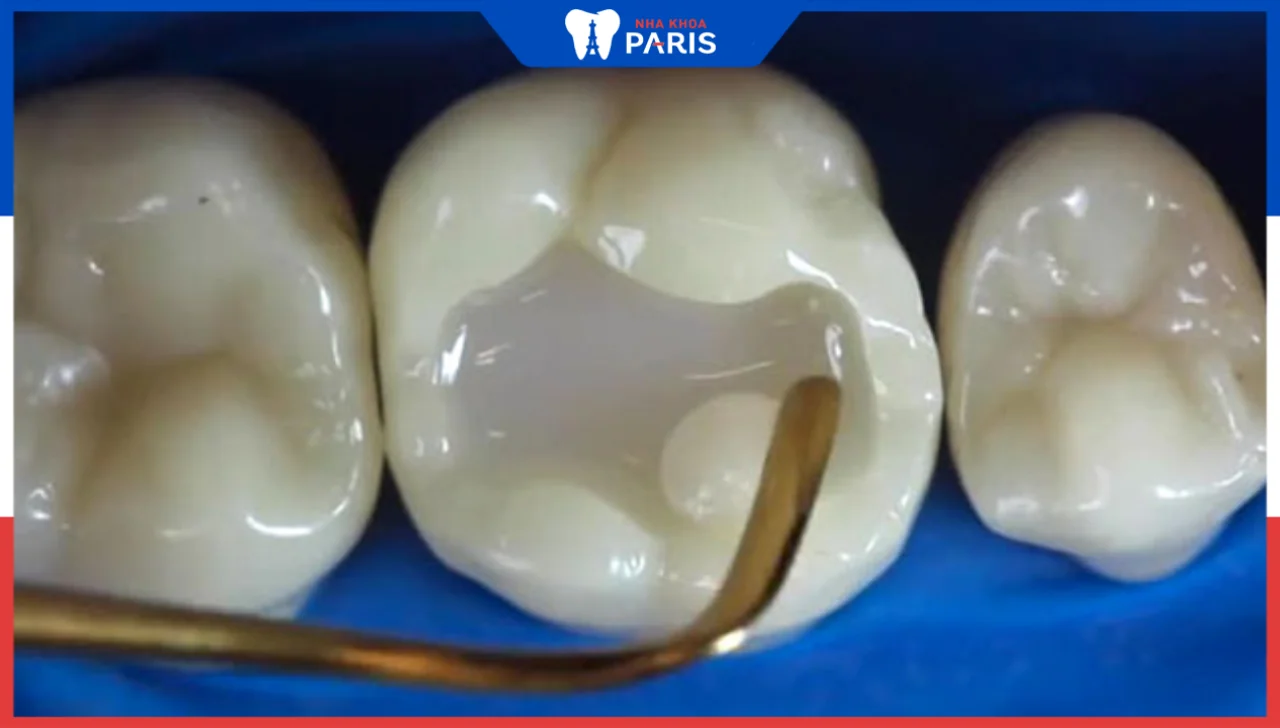 Các loại xoang răng phổ biến – Phương pháp trám răng hiệu quả
