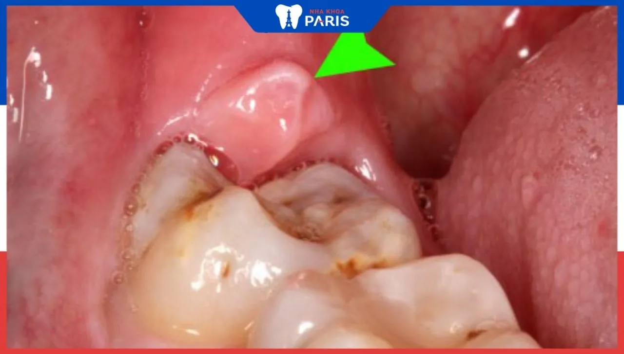 8 Dấu hiệu mọc răng khôn phổ biến : Bác sĩ nha khoa cho biết