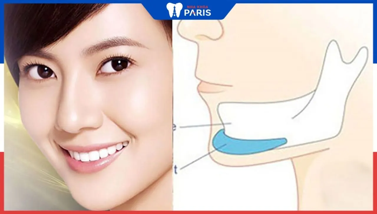 Độn cằm bao lâu thì lành? Những lưu ý khi độn cằm mà bạn cần biết