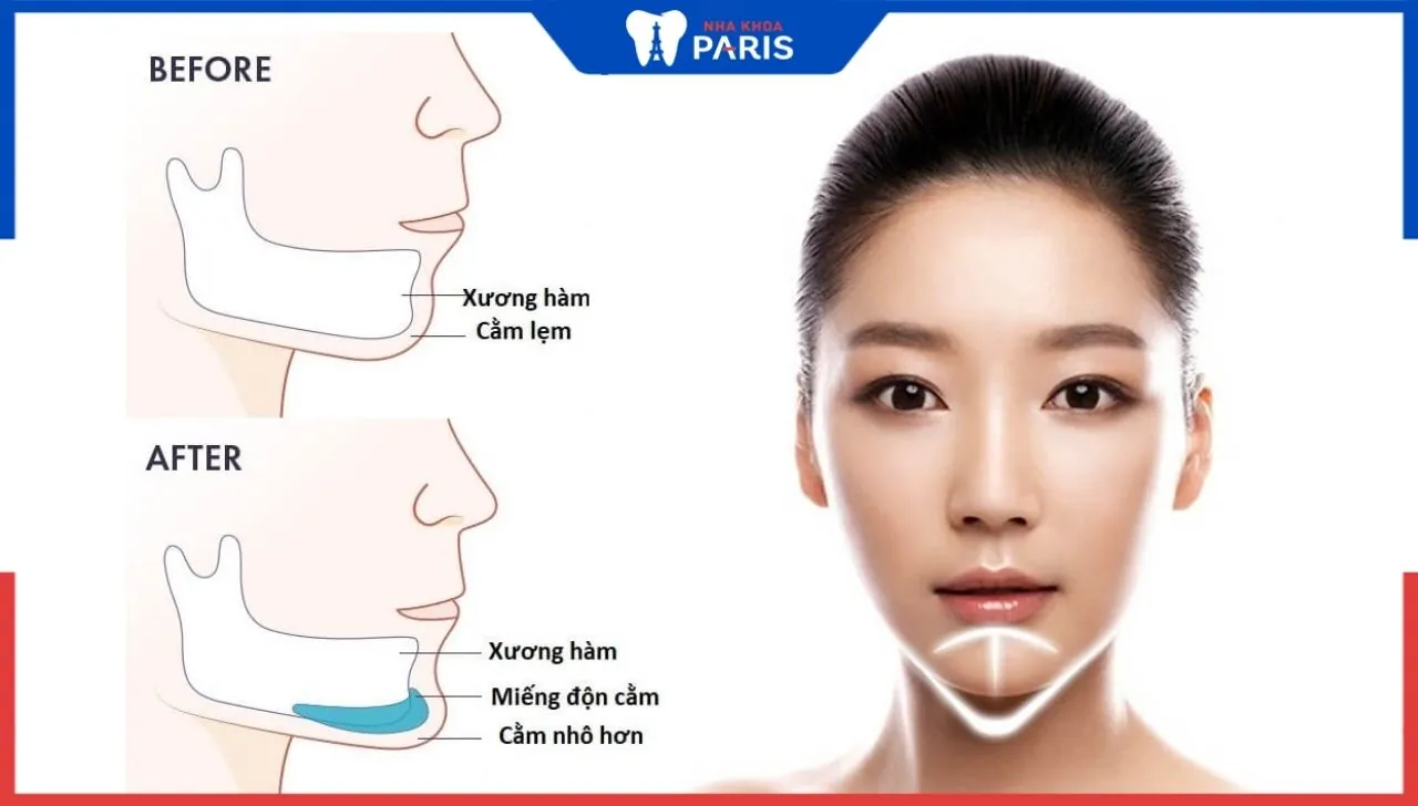Độn cằm có đau không? Đau mấy ngày? Chuyên gia giải đáp