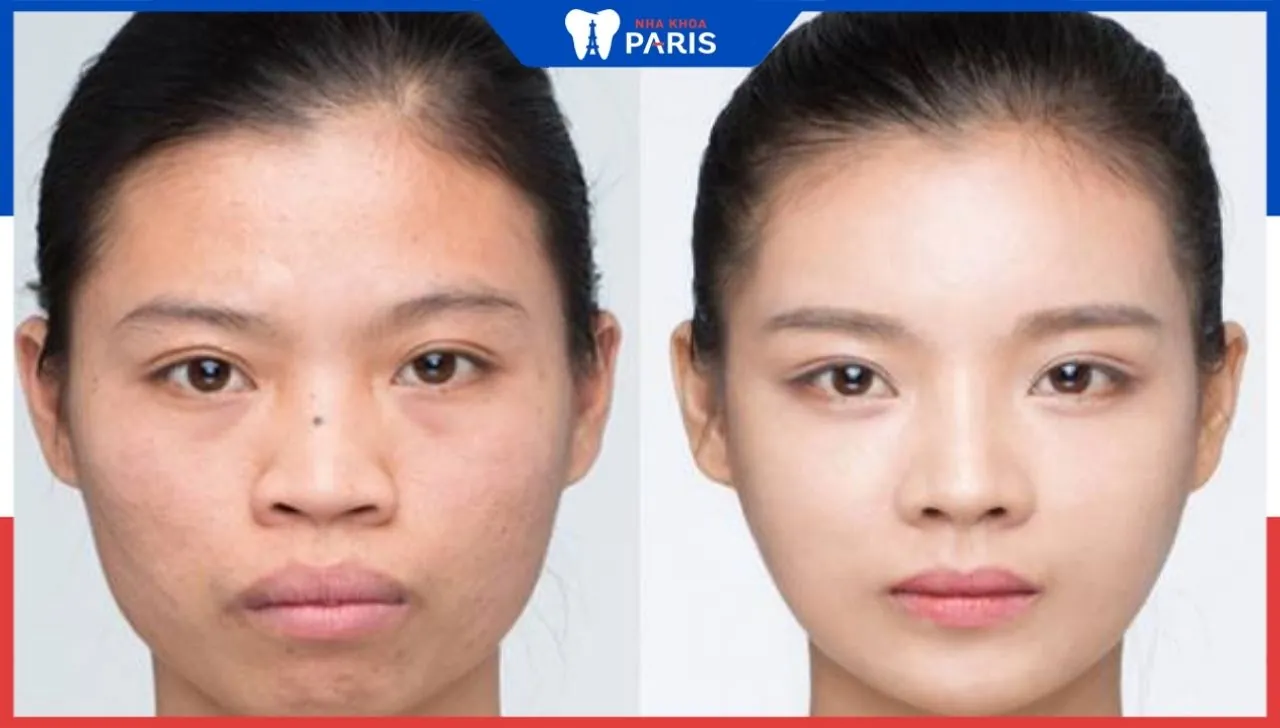 Độn cằm có nguy hiểm không, có bị hỏng cằm vĩnh viễn không?
