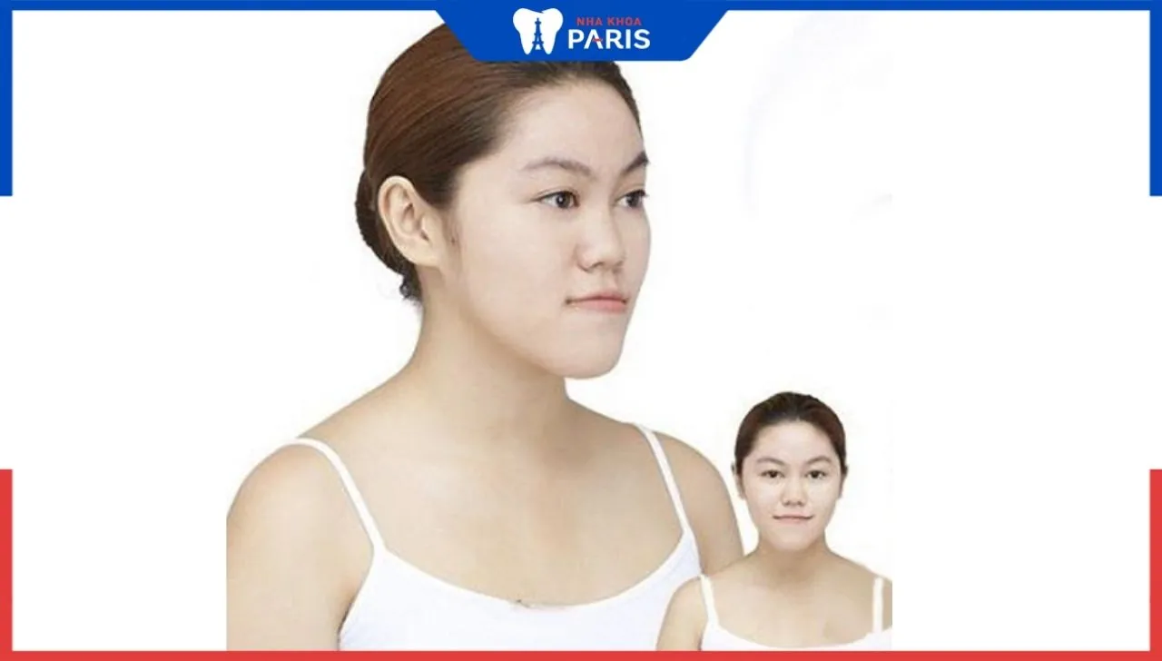Độn cằm xong bị móm xử lý thế nào? Cách khắc phục nhanh chóng