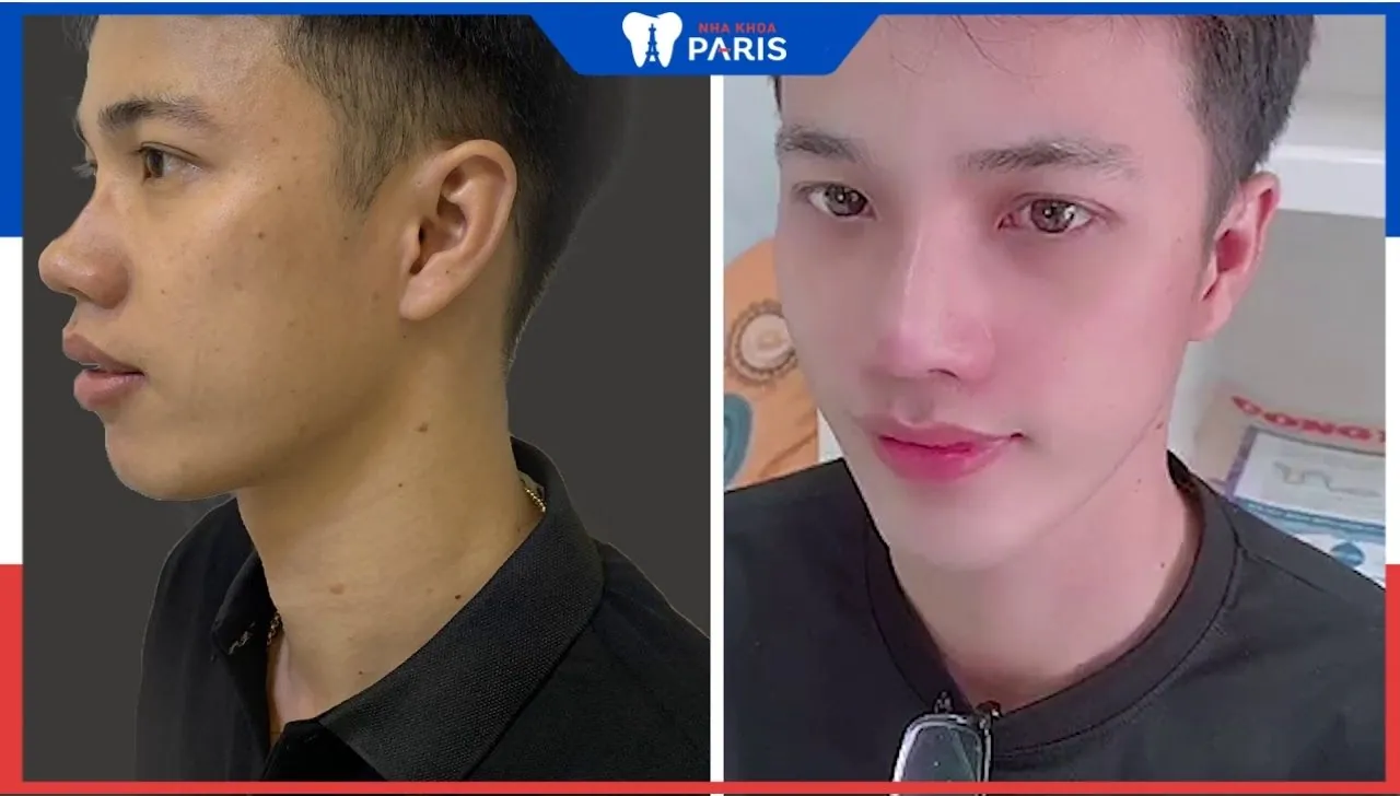 Độn cằm nam – Xu Hướng Làm Đẹp Thịnh Hành Chuẩn Soái Ca