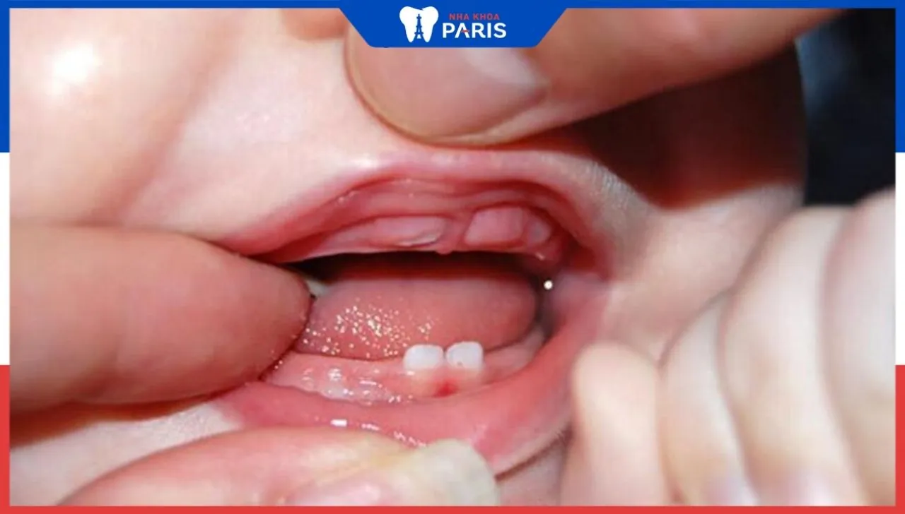 Giai đoạn mọc răng của trẻ và lịch mọc răng đầy đủ của trẻ