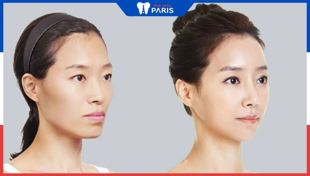 Hạ gò má ở đâu đẹp, uy tín,an toàn – Nha Khoa Paris