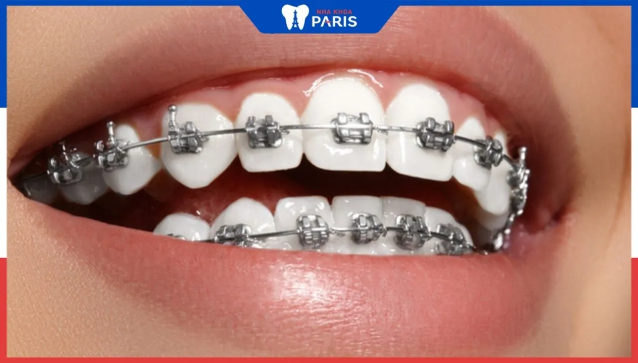 Cách làm trắng răng khi niềng- An toàn, hiệu quả