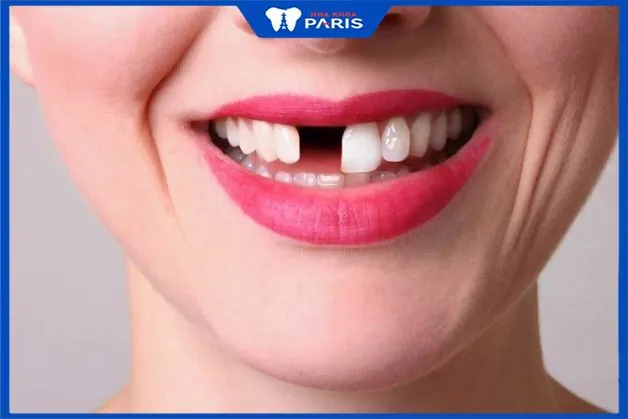 Nhổ răng cửa có đau không – 3 Phương pháp giảm đau nhanh