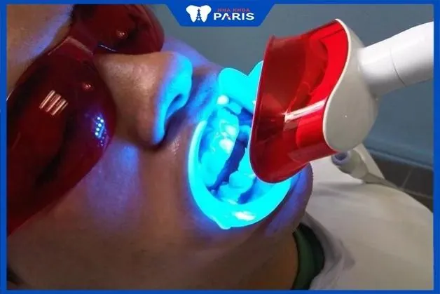 Giải đáp thắc mắc: Tẩy trắng răng có an toàn không?
