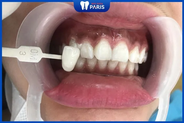5 Tiêu chí lựa chọn địa chỉ tẩy trắng răng uy tín tại Vinh
