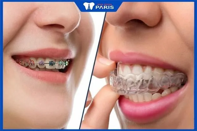 Niềng răng tại Vinh-Nghệ An: Địa chỉ nha khoa uy tín