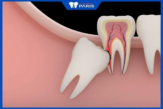Mách bạn địa chỉ nhổ răng khôn uy tín tại Quận Tân Bình