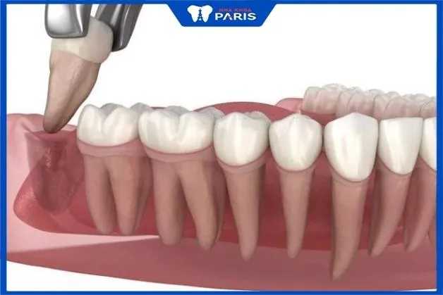 TOP 1 địa chỉ nhổ răng khôn uy tín tại Vinh