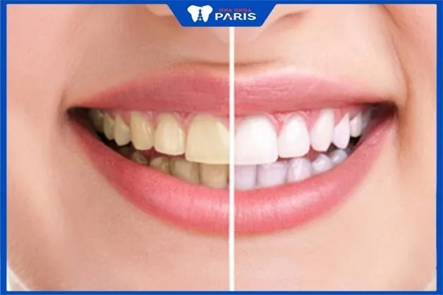 5 Tiêu chí chọn địa chỉ tẩy trắng răng uy tín tại Thủ Dầu Một