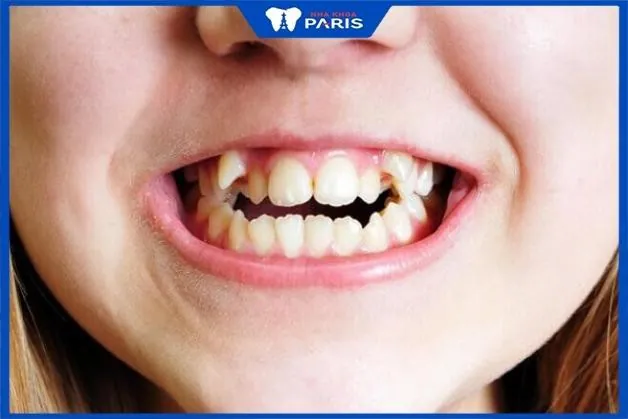 Răng khểnh có nên niềng không? Tìm hiểu ngay trước khi quyết định