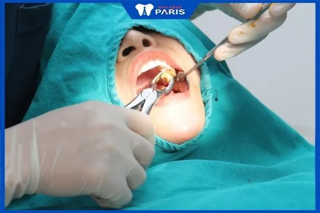 Hé lộ TOP 5 bác sĩ nhổ răng khôn giỏi ở Hà Nội bạn nên chọn