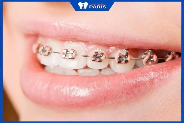 Niềng răng hô hàm trên giá bao nhiêu? Địa chỉ niềng uy tín