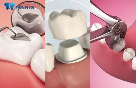Răng hàm sâu bị vỡ nên làm gì: Trám, bọc sứ hay nhổ bỏ?