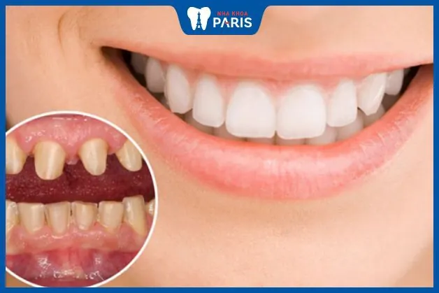 Bao nhiêu tuổi thì bọc răng sứ được | Những lưu ý quan trọng