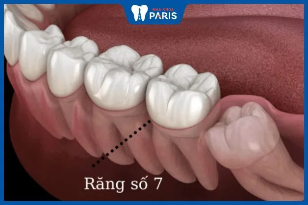 Góc giải đáp: Nhổ răng số 7 có ảnh hưởng thần kinh không
