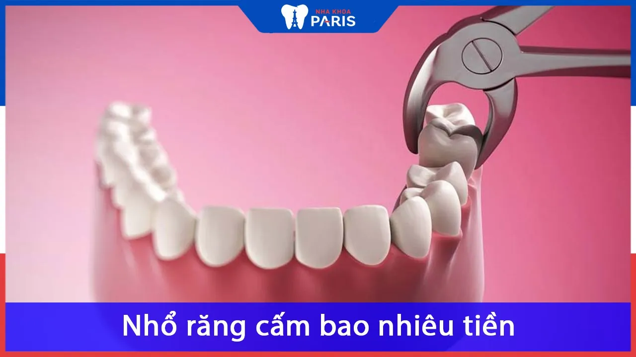 Nhổ răng cấm được thực hiện khi nào, những lưu ý quan trọng